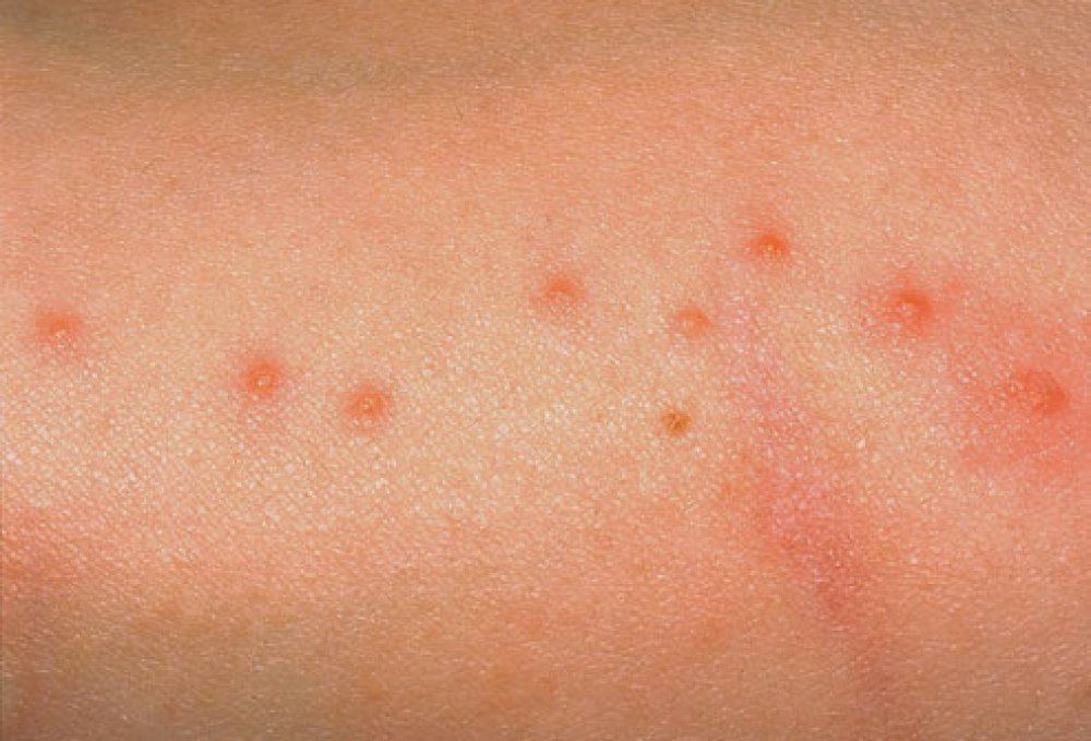 What Do Bed Bug Bites Look Like? – GP Home Defense, LLC